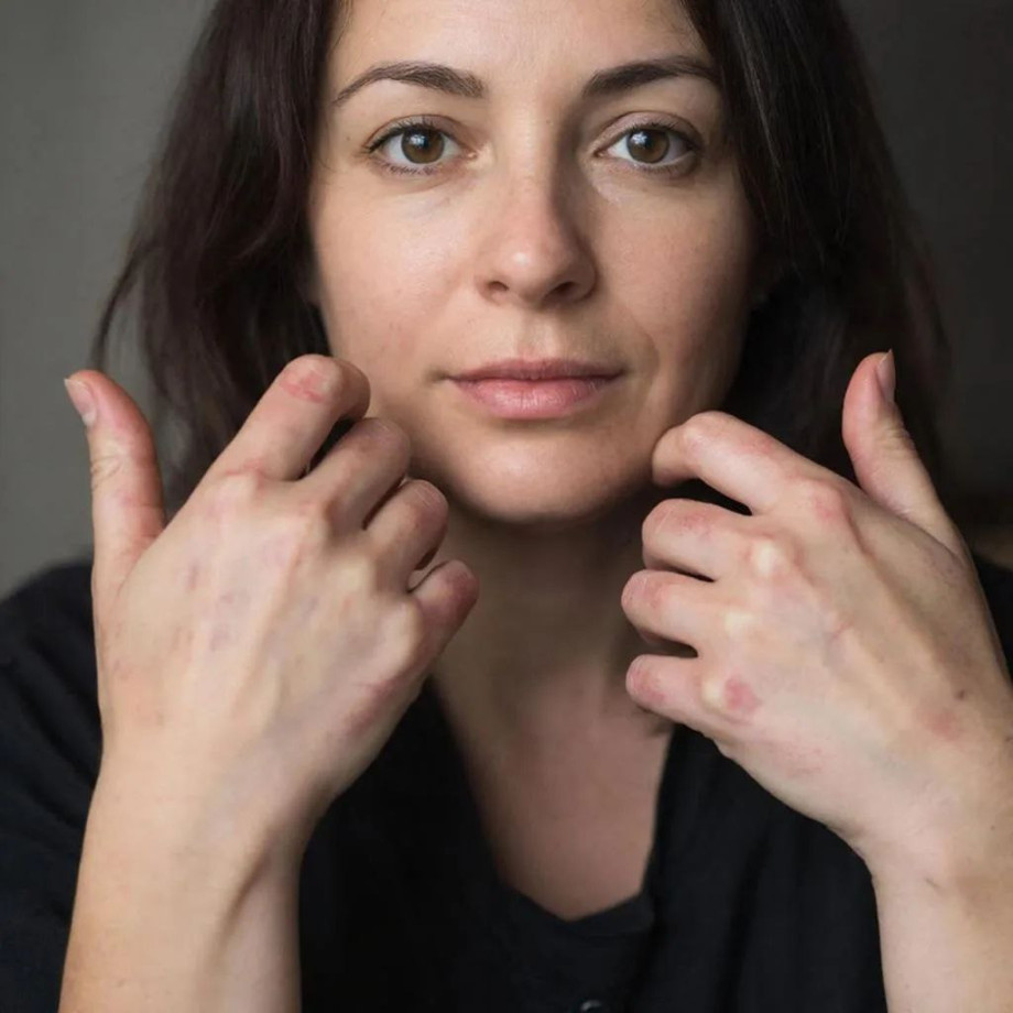 Аллергия на нервной почве когда мир становится слишком острым чтобы его принимать